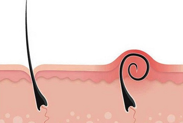 Cách nhổ râu không mọc lại