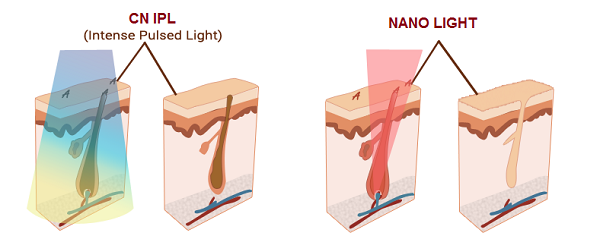 công nghệ triệt lông IPL