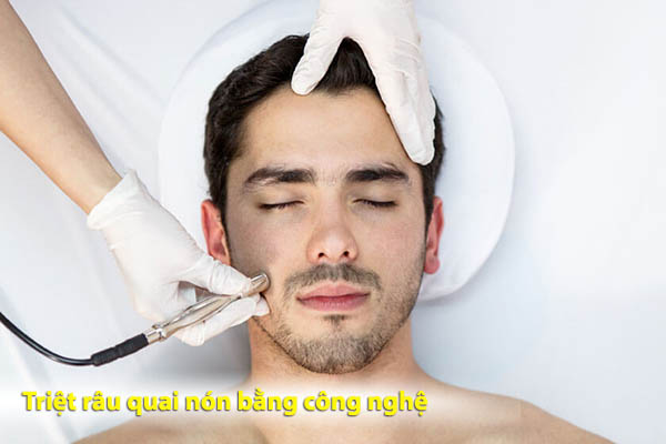 Râu quai nón có triệt được không