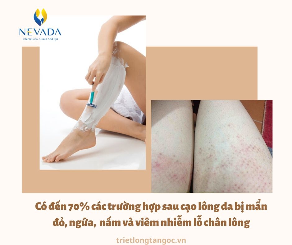 có nên đi triệt lông tay chân vĩnh viễn không, Review triệt lông vĩnh viễn, có nên triệt lông vĩnh viễn không, có nên tẩy lông vĩnh viễn không, có nên triệt lông vĩnh viễn ko, có nên triệt lông chân vĩnh viễn không, có nên đi triệt lông vĩnh viễn không, có nên triệt lông mép vĩnh viễn không, có nên triệt lông vĩnh viễn hay không, có nên tẩy lông chân, tẩy lông chân có ảnh hưởng gì không, tẩy lông có ảnh hưởng gì không, triệt lông chân có ảnh hưởng gì không, tẩy lông chân nhiều có tốt không, tẩy lông chân có hại không, có nên tẩy lông tay chân không, có nên tẩy lông tay không, có nên triệt lông tay không, có nên triệt lông chân, tẩy lông tay chân có tốt không, có nên triệt lông chân không, có nên tẩy lông chân không, có nên tẩy lông chân hay không, có nên tẩy lông không, triệt lông tay chân có ảnh hưởng gì không, tẩy lông có tốt không, có nên tẩy lông, tẩy lông tay có sao không, triệt lông có tốt không, triệt lông chân có hại không, triệt lông vĩnh viễn có ảnh hưởng gì không, triệt lông có ảnh hưởng gì không, tẩy lông chân có tốt không