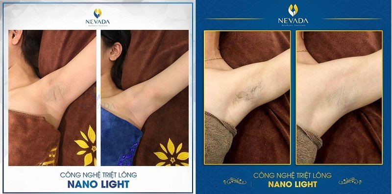 Triệt lông bằng công nghệ Master Laser