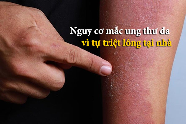 triệt lông vĩnh viễn có gây ung thư da không, triệt lông vĩnh viễn có gây ung thư, triệt lông vĩnh viễn có gây ung thư da