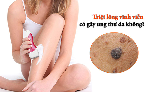 triệt lông vĩnh viễn có gây ung thư da không, triệt lông vĩnh viễn có gây ung thư, triệt lông vĩnh viễn có gây ung thư da