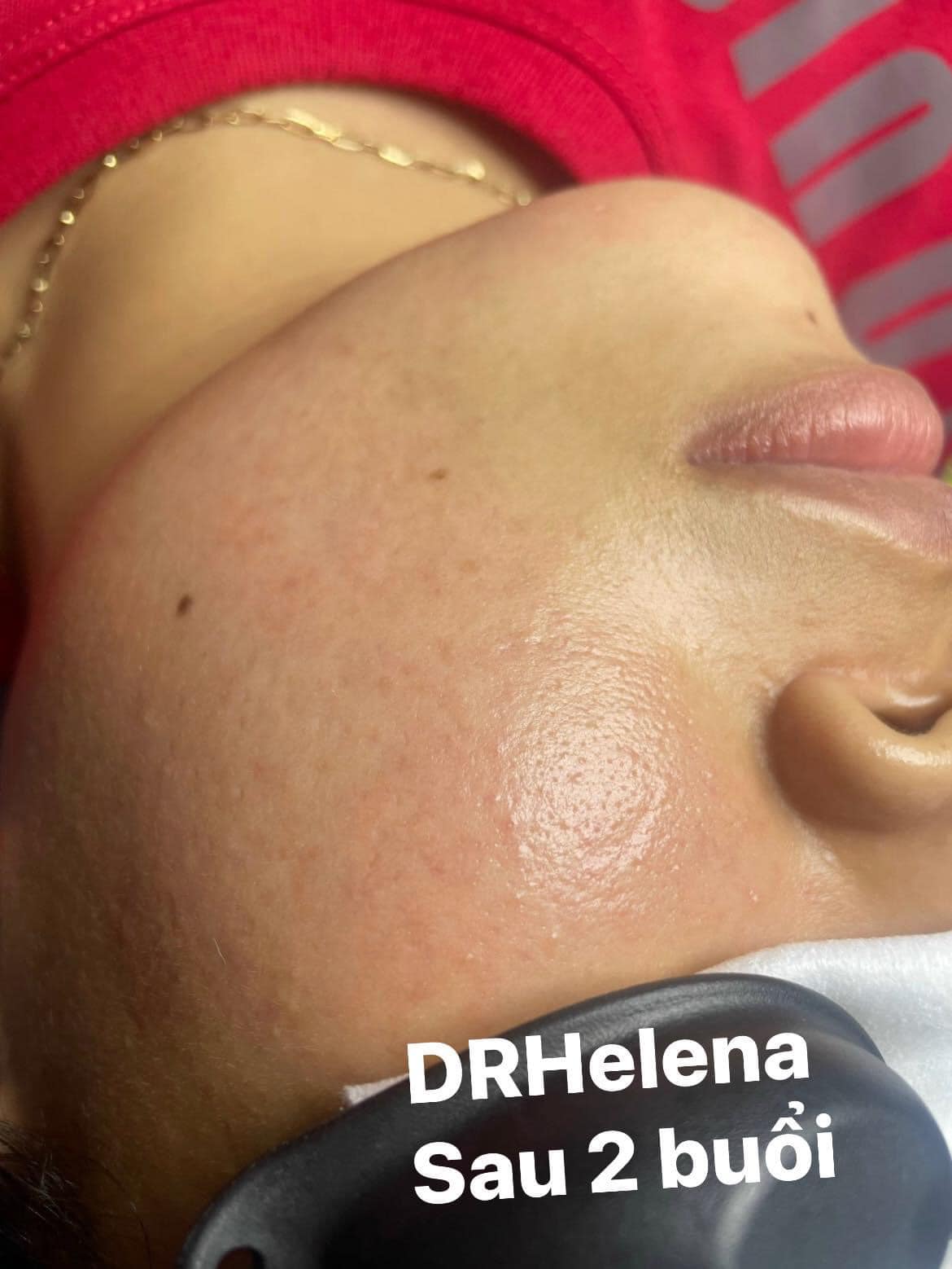 detox melasma x7 khách hàng