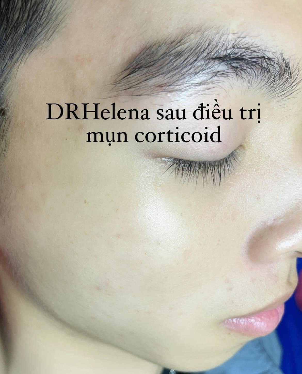 hình ảnh detox melasma x7 từ người dùng