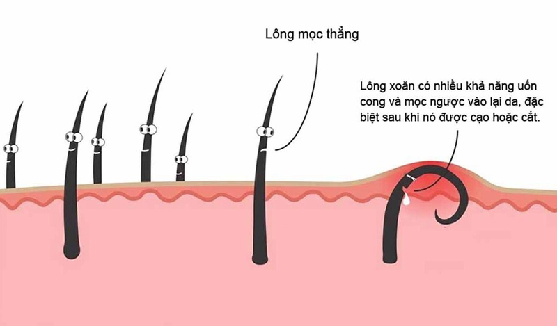 lông mọc ngược