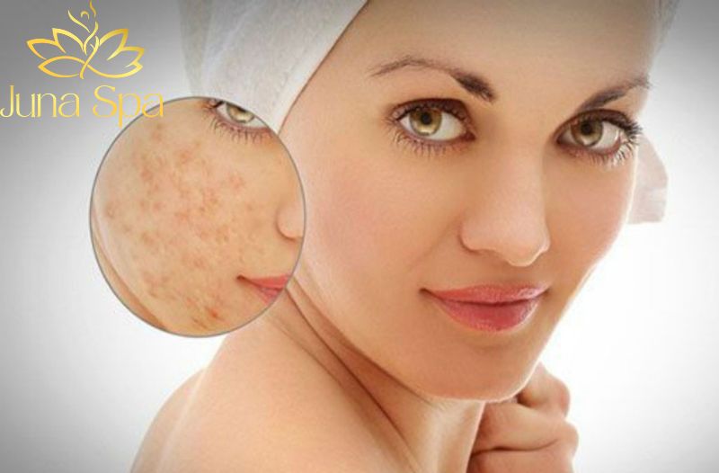 Trị sẹo thâm ở nhà một cách dễ dàng